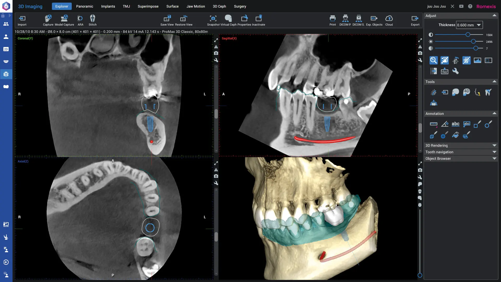 Romexis_Screenshot-3D-Implant-Planning_3840px